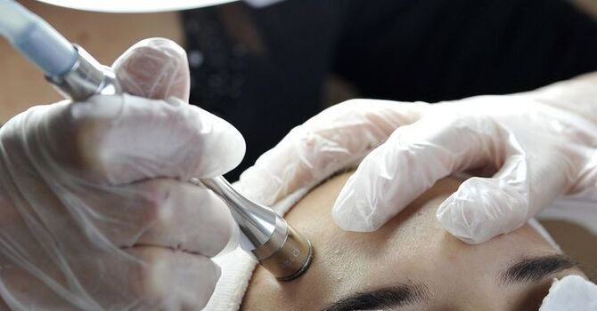 90 MINUTES MICRODERMABRASION